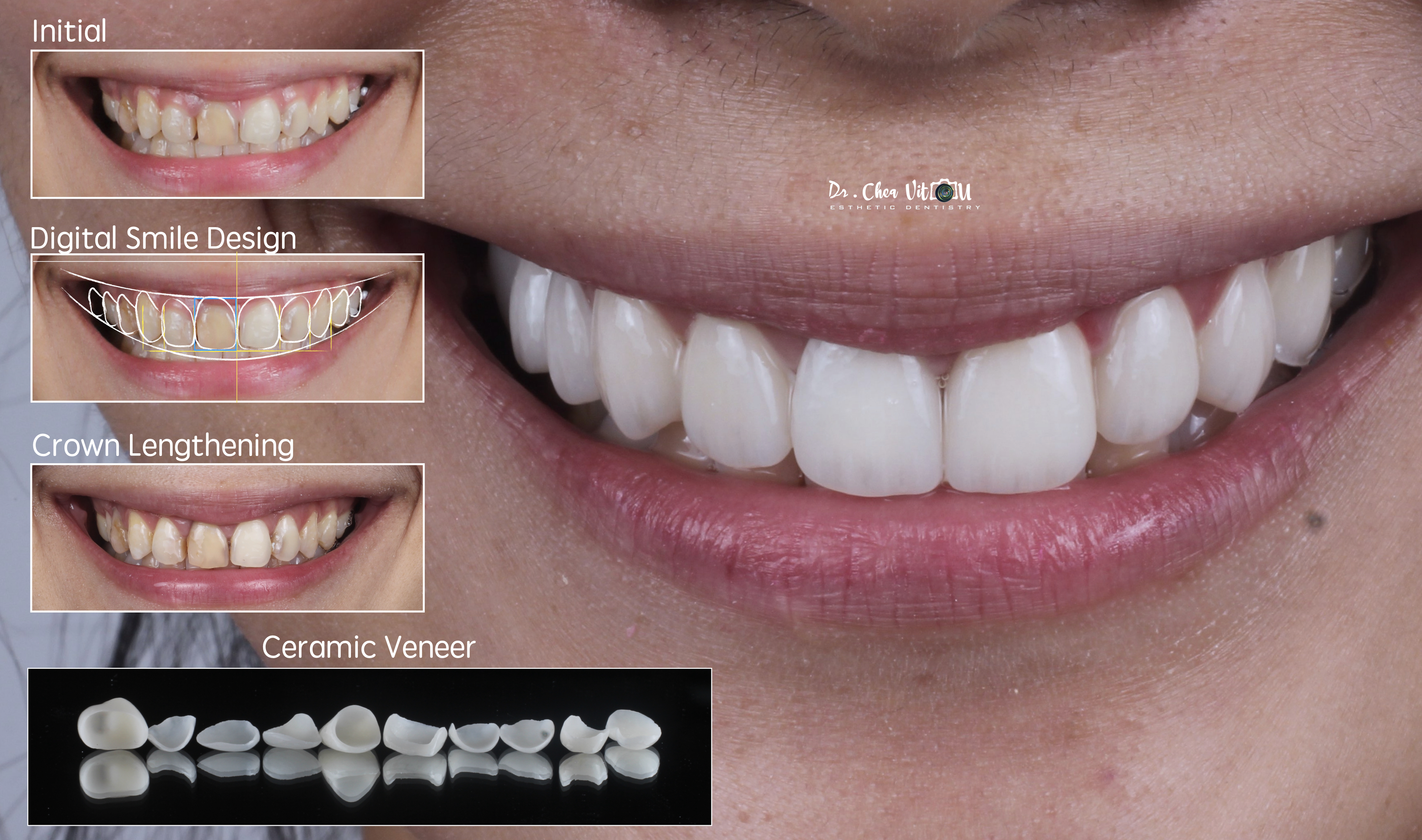 case image